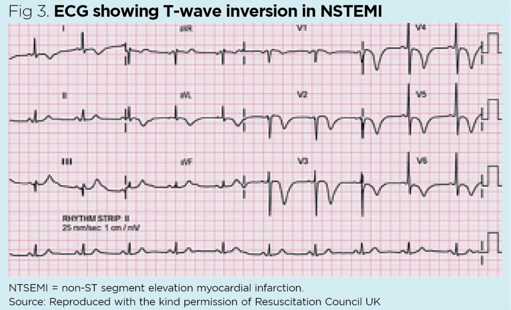 ECG Screening
